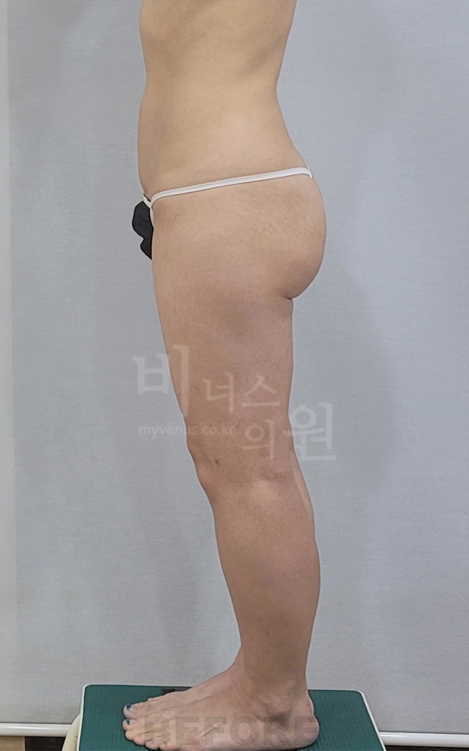 엉덩이 지방흡입 수술 전 측면