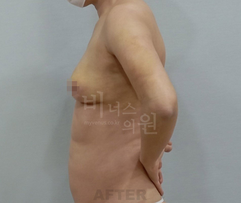 가슴축소 지방흡입 측면 수술 후 비너스의원