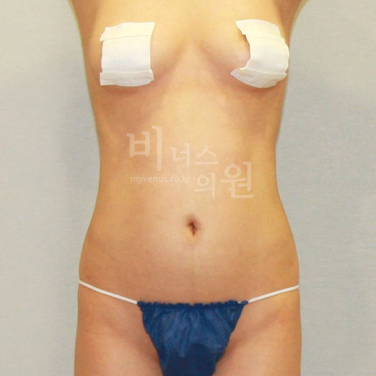 정면 수술 후 비너스의원