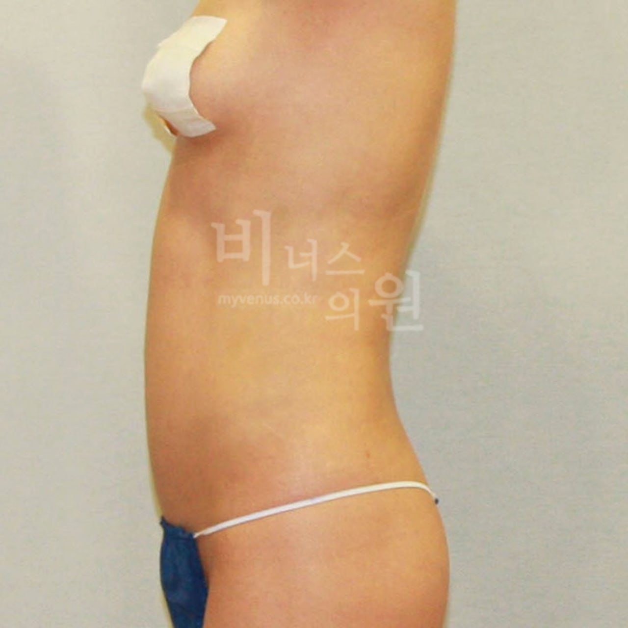 측면 수술 후 비너스의원