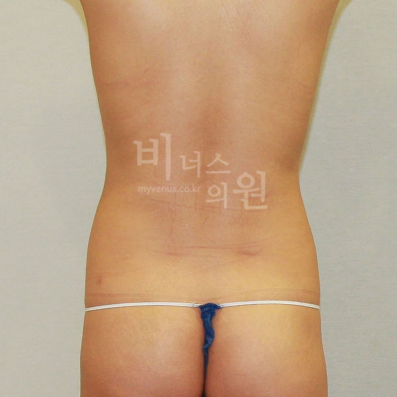 후면 수술 전 비너스의원