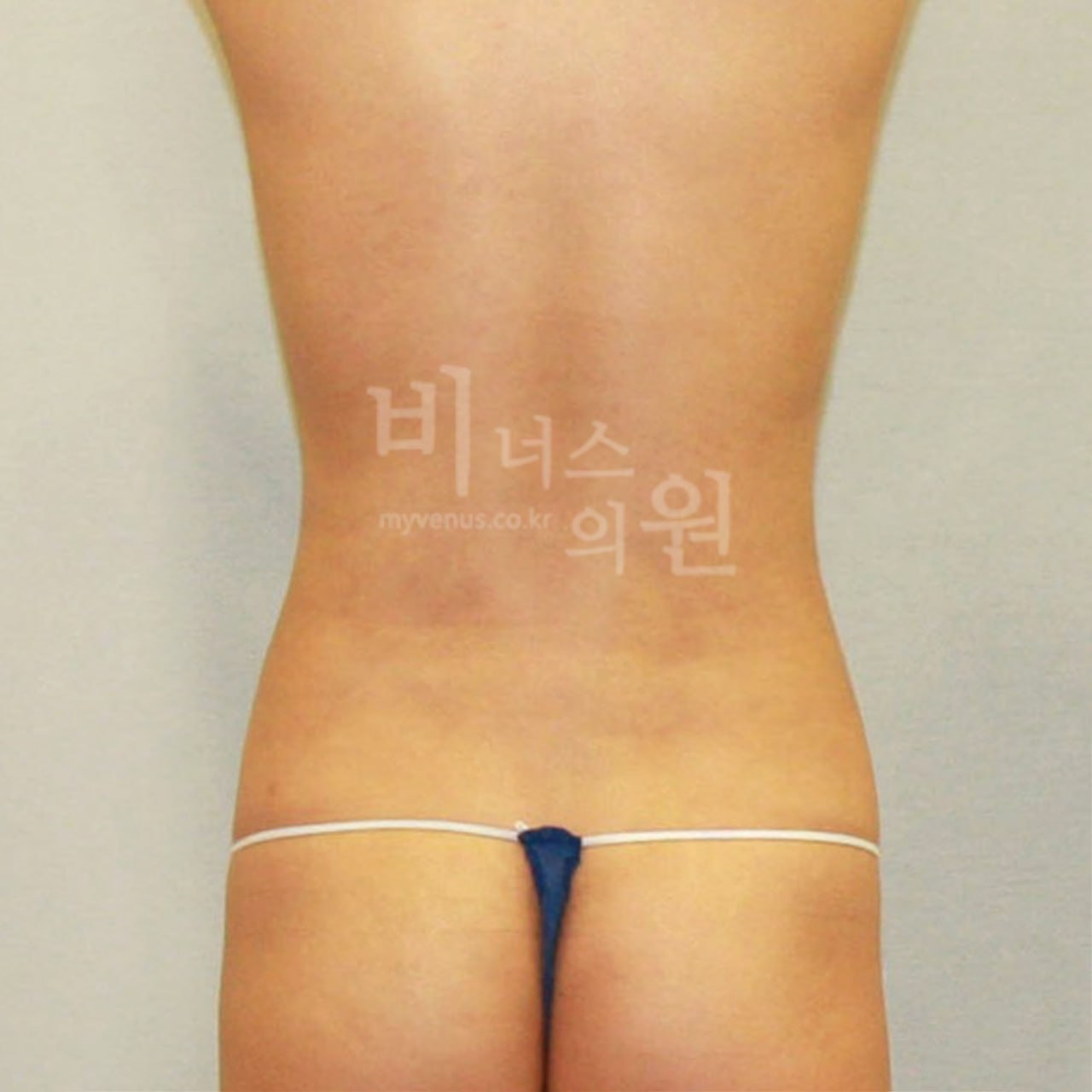 후면 수술 후 비너스의원