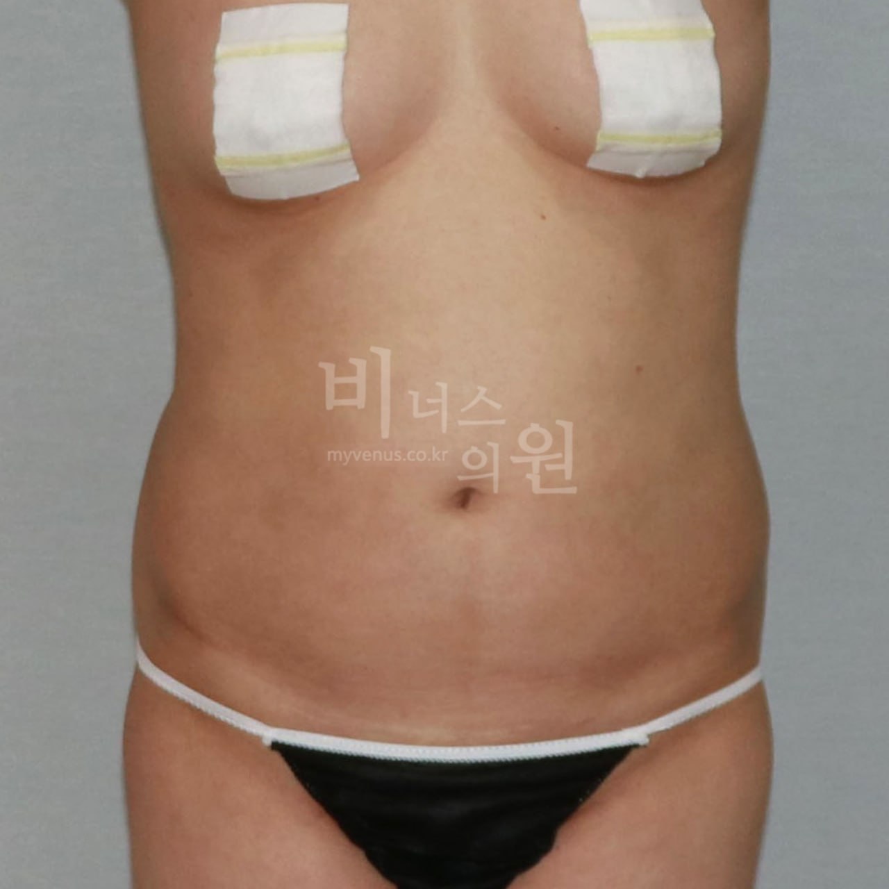 정면 수술 전 비너스의원