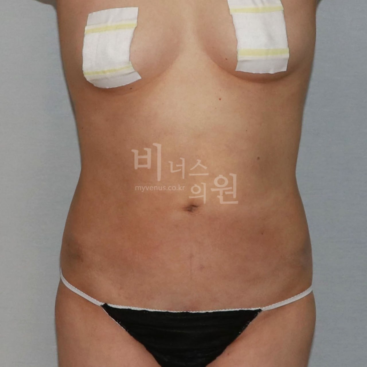 정면 수술 후 비너스의원