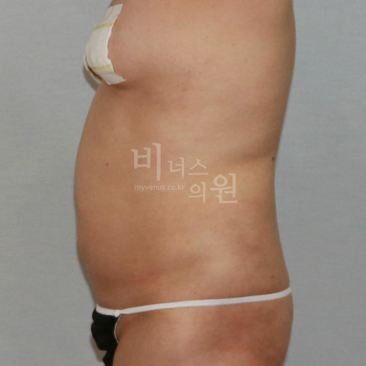 우측면 수술 전 비너스의원