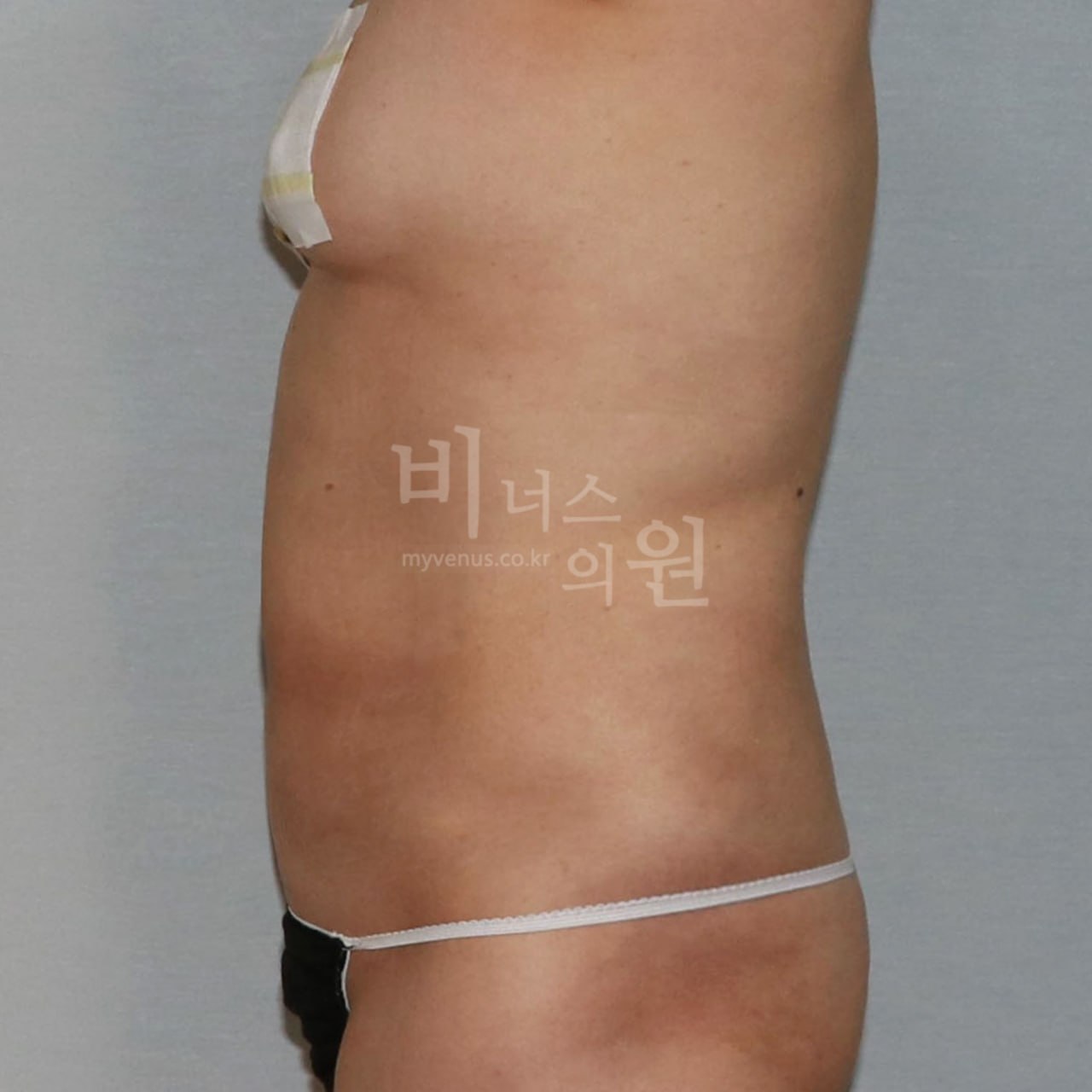 우측면 수술 후 비너스의원