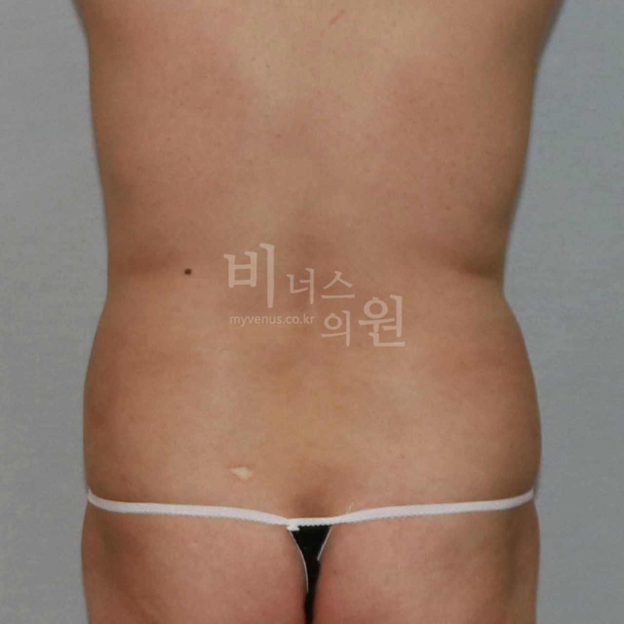 후면 수술 전 비너스의원