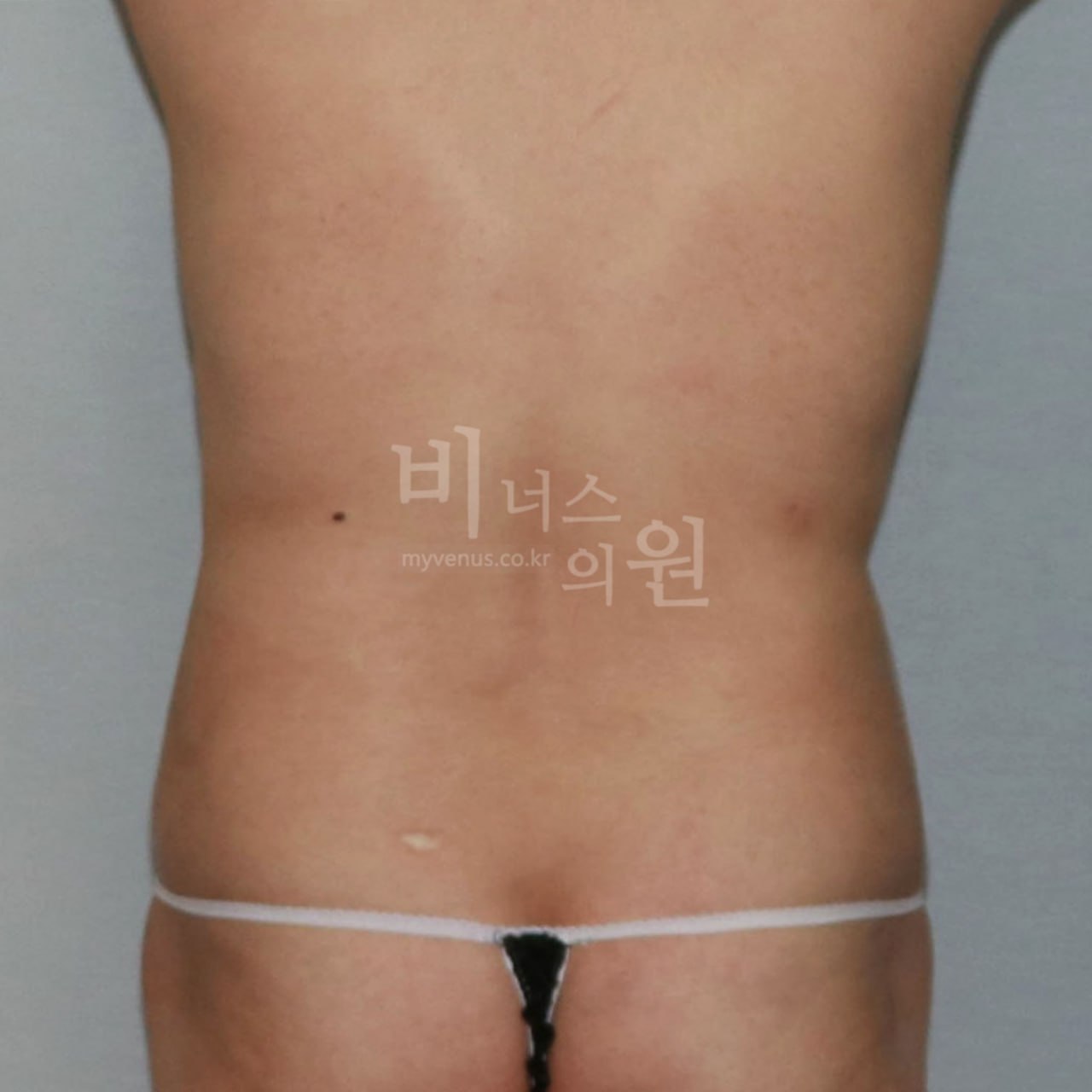 후면 수술 후 비너스의원