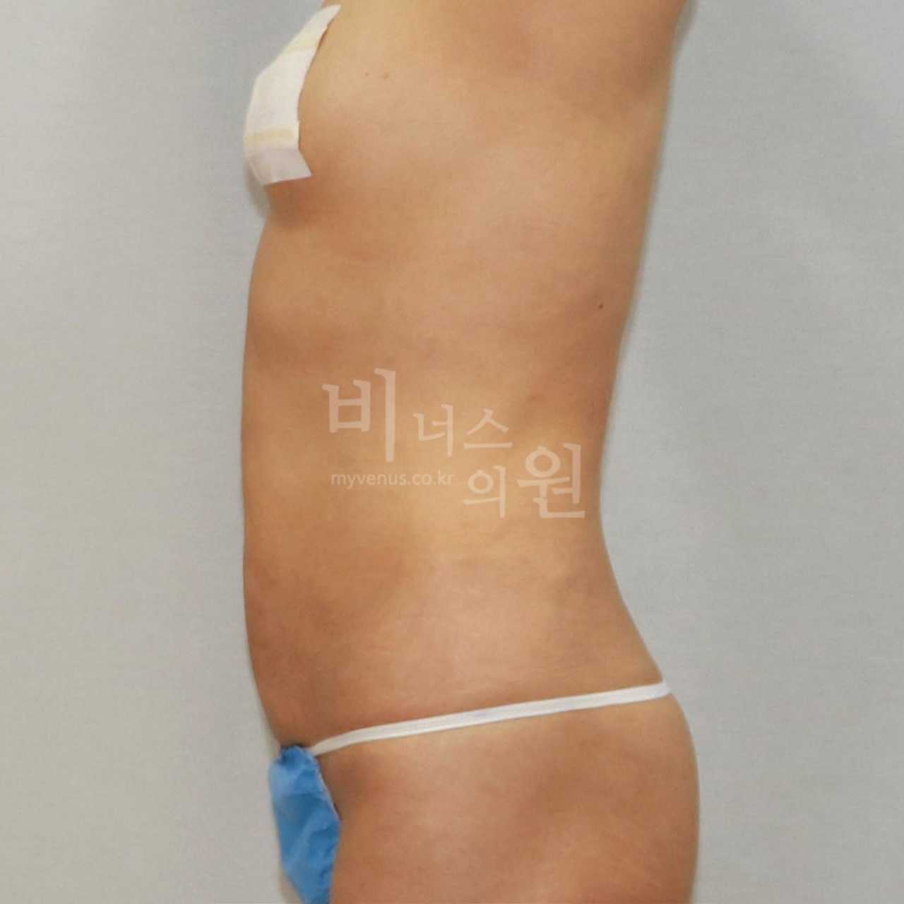 우측면 수술 후 비너스의원