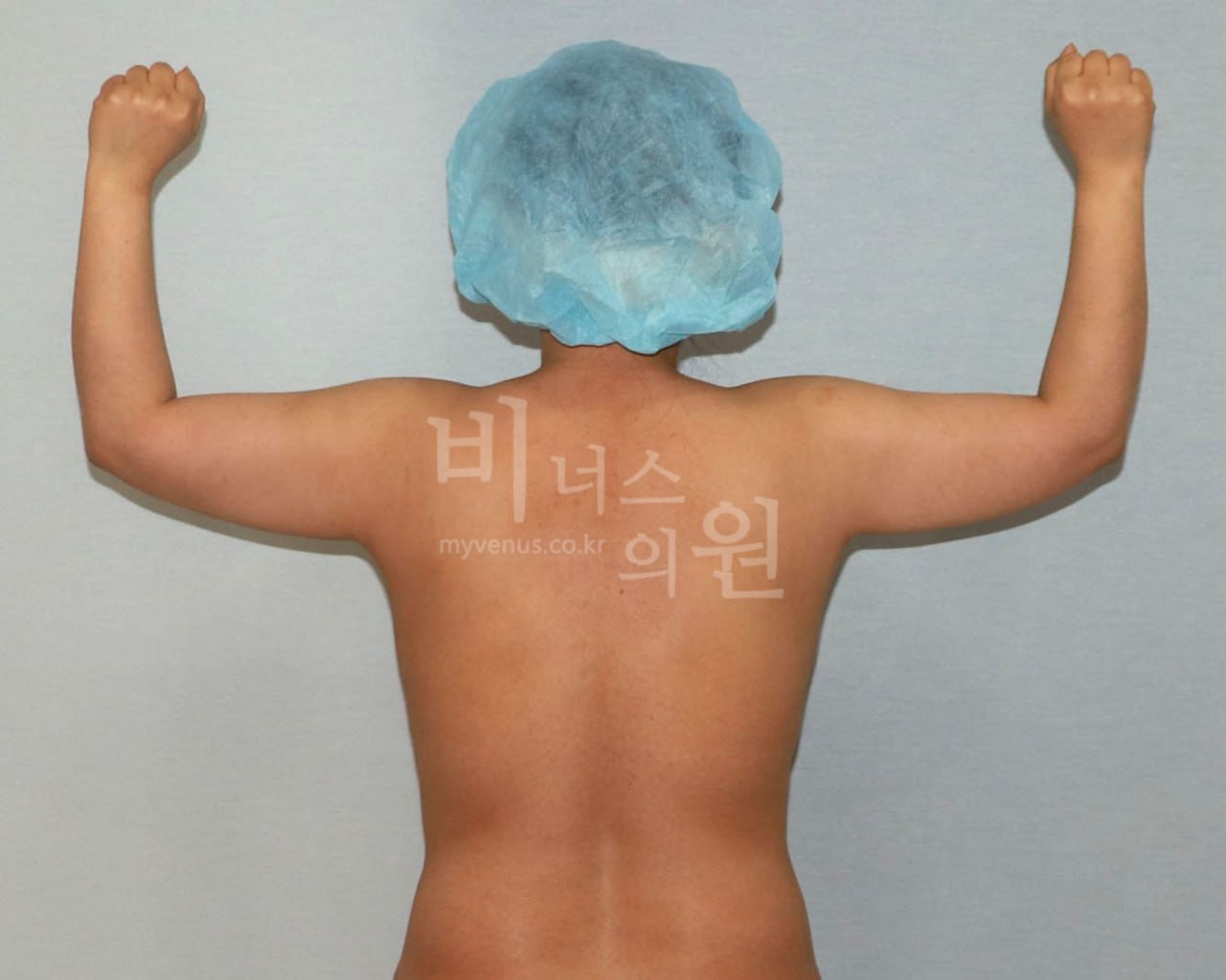 팔뚝 지방흡입 수술 전 Case 1