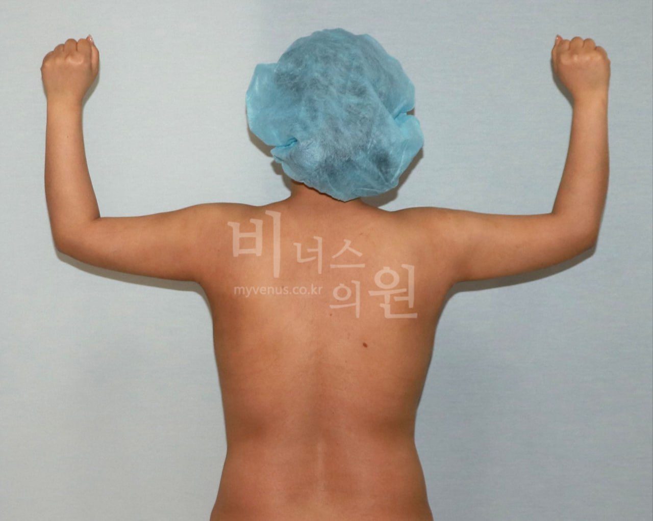 팔뚝 지방흡입 수술 후 Case 1