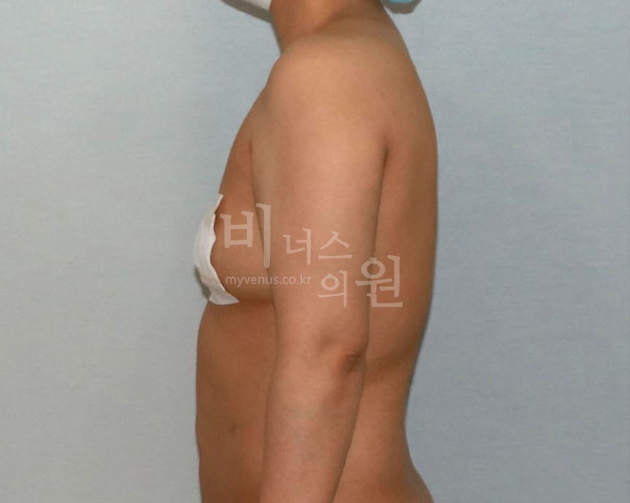 팔뚝 지방흡입 수술 전 Case 2