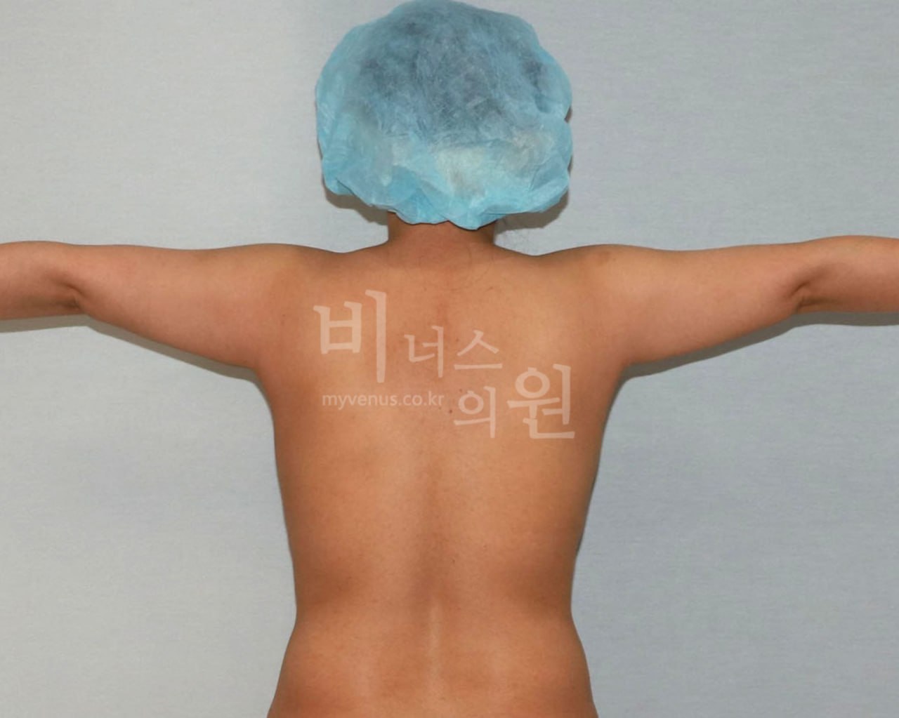 팔뚝 지방흡입 수술 전 Case 3