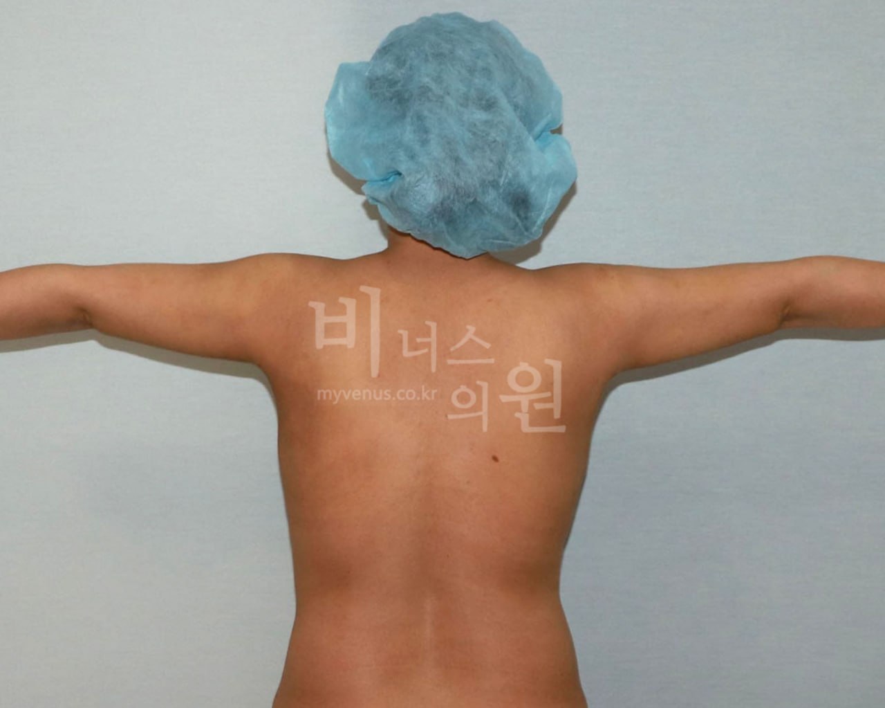 팔뚝 지방흡입 수술 후 Case 3