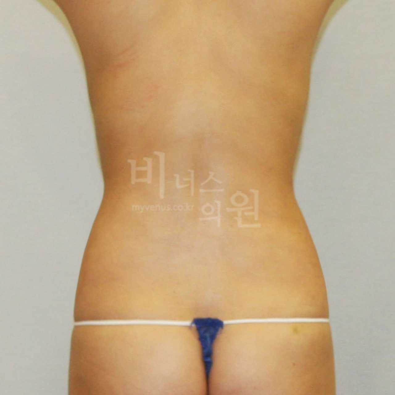 복부 지방흡입 수술 후 후면 비너스의원 부천