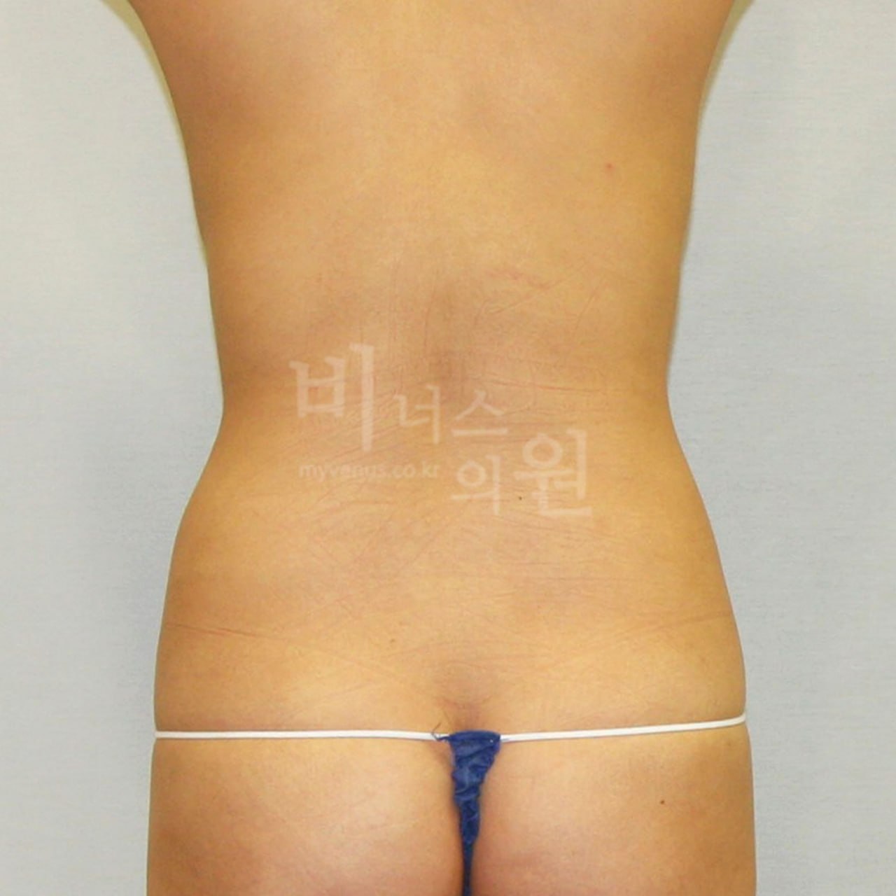 복부 지방흡입 수술 전 후면 비너스의원 부천
