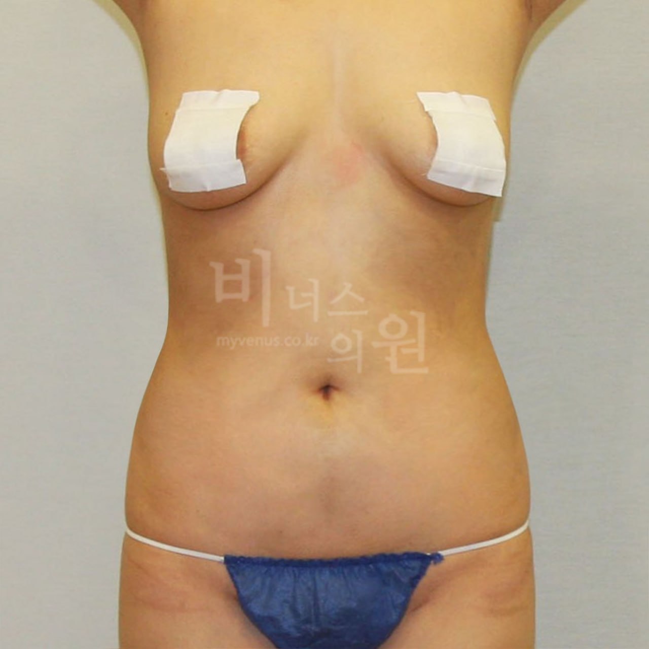 복부 지방흡입 수술 후 정면 비너스의원 부천