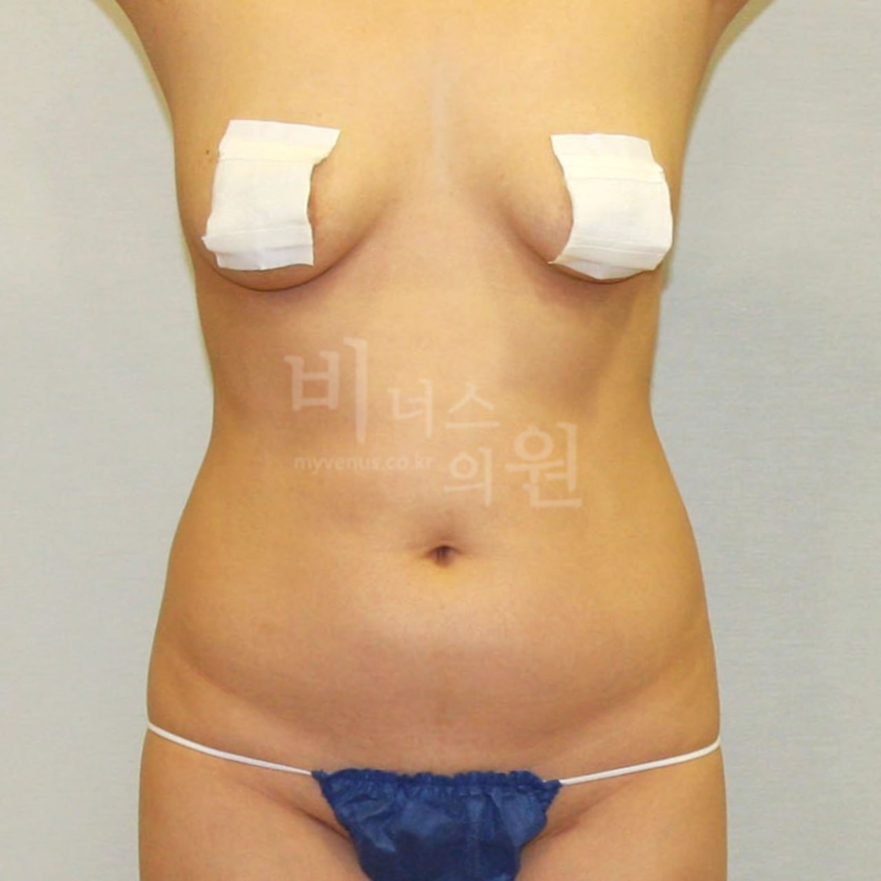 복부 지방흡입 수술 전 정면 비너스의원 부천