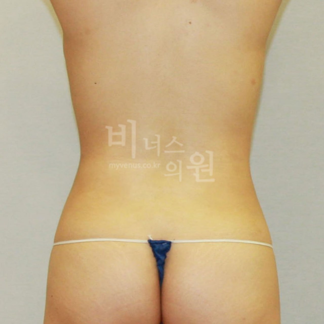 복부 지방흡입 수술 후 후면 비너스의원 부천