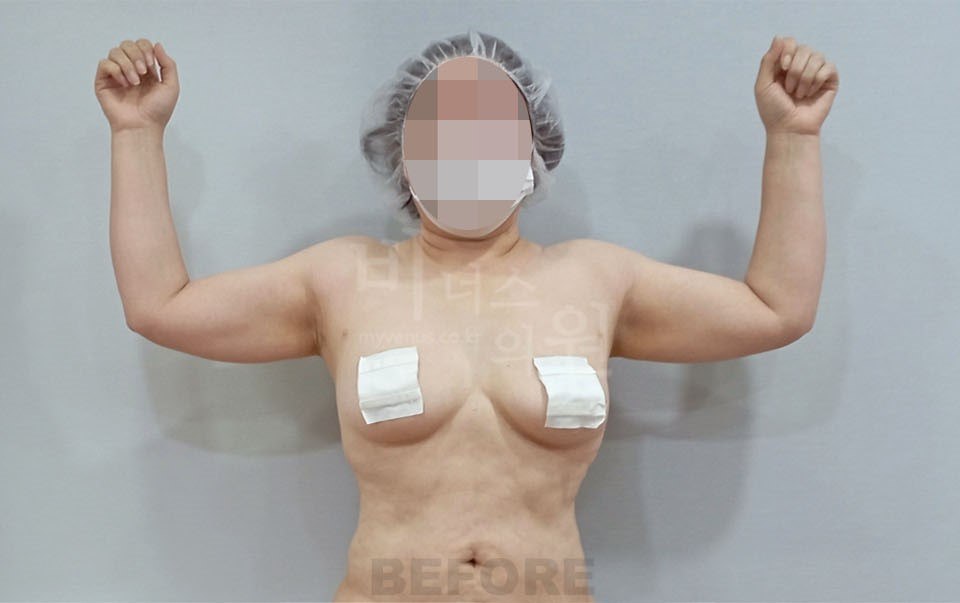 팔뚝 지방흡입 수술 전 정면 팔올림