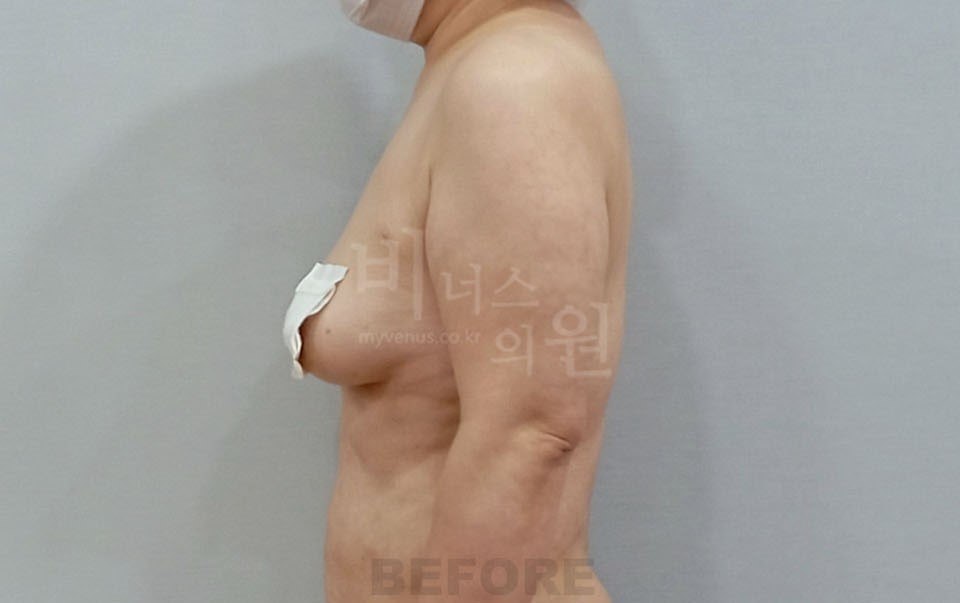 팔뚝 지방흡입 수술 전 측면