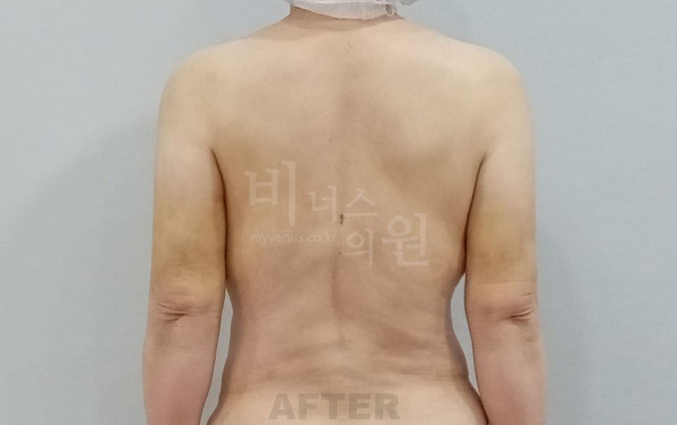 팔뚝 지방흡입 수술 후 후면