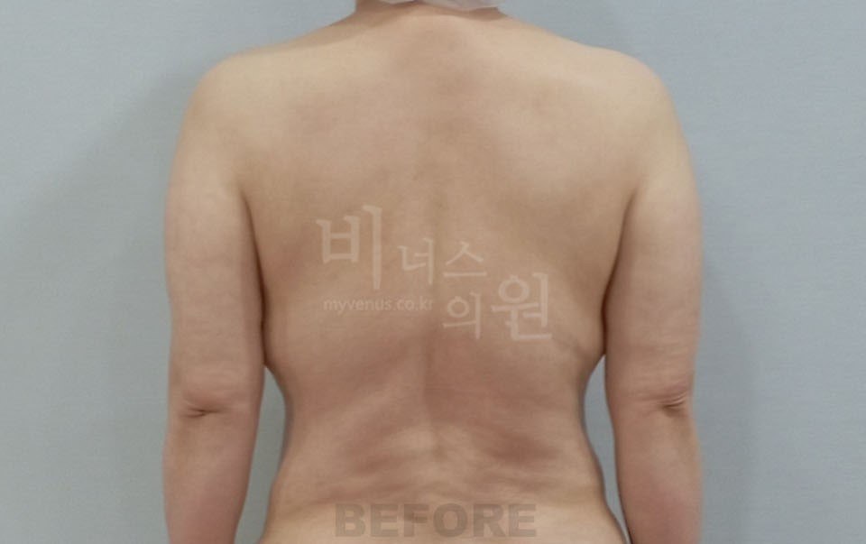 팔뚝 지방흡입 수술 전 후면