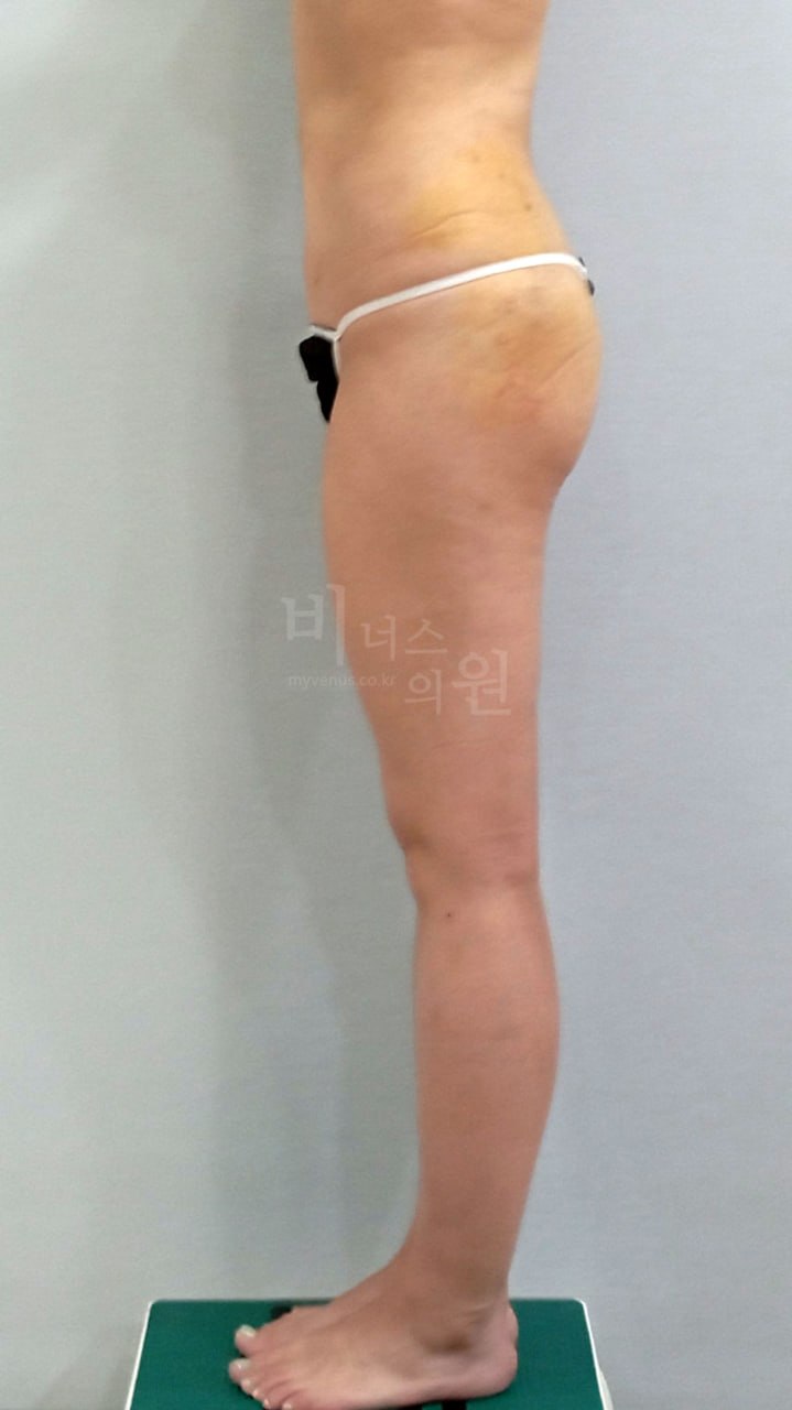 엉덩이 지방흡입 수술 후 측면 (2) 비너스의원