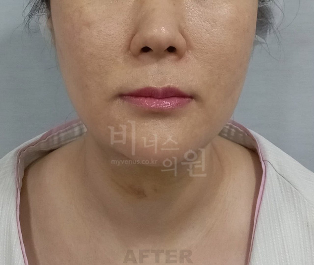 얼굴 이중턱 지방흡입 수술 후 정면 비너스의원