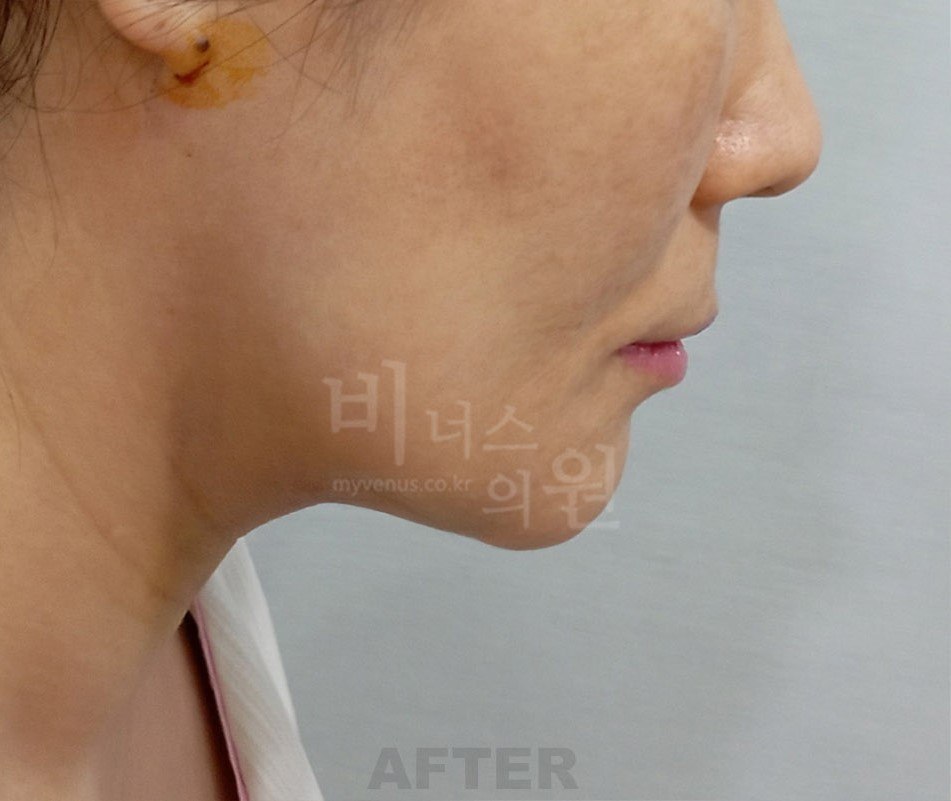 얼굴 이중턱 지방흡입 수술 후 왼측면 비너스의원