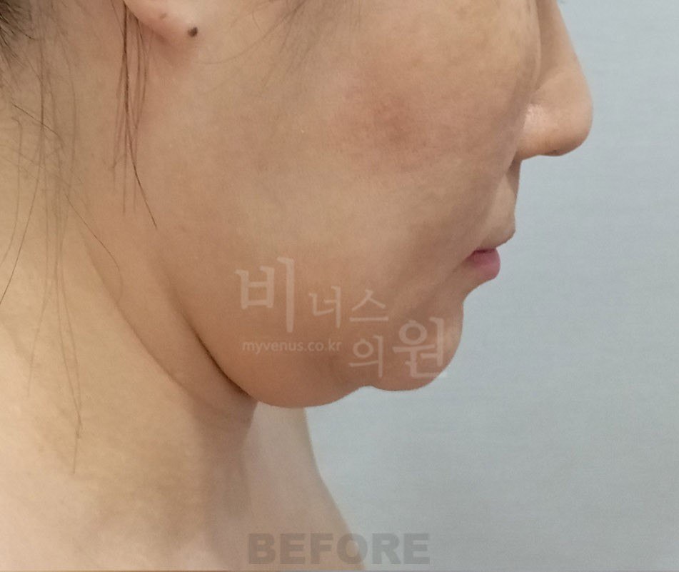 얼굴 이중턱 지방흡입 수술 전 왼측면 비너스의원
