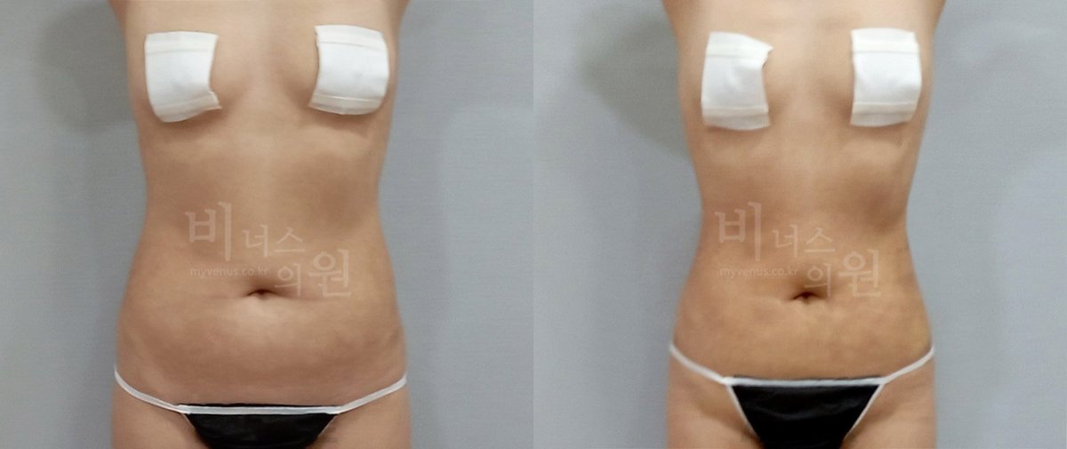 복부 지방흡입 전후사진 전면 전후 - 비너스의원