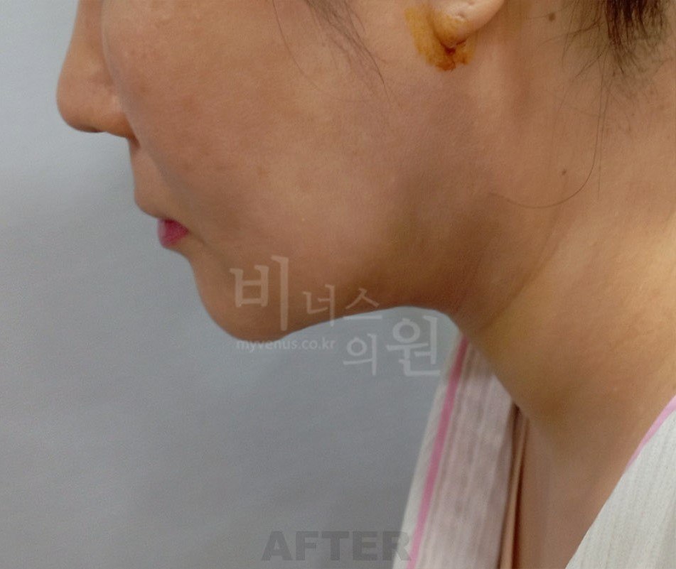 얼굴 이중턱 지방흡입 수술 후 우측면 비너스의원