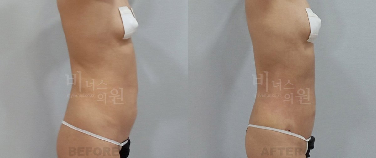 복부 지방흡입 전후사진 측면2 전후 - 비너스의원