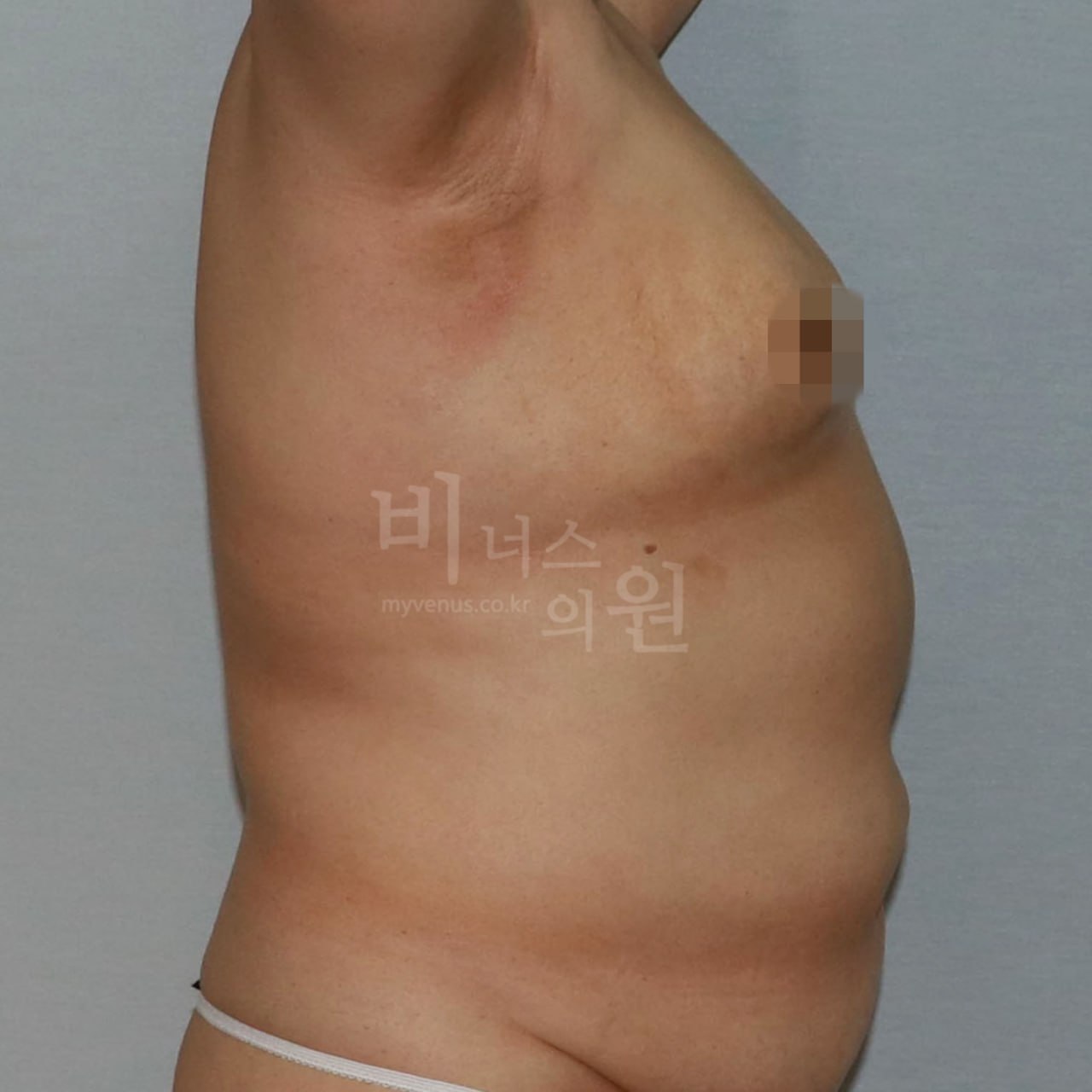 가슴축소 지방흡입 전후사진 CASE 6