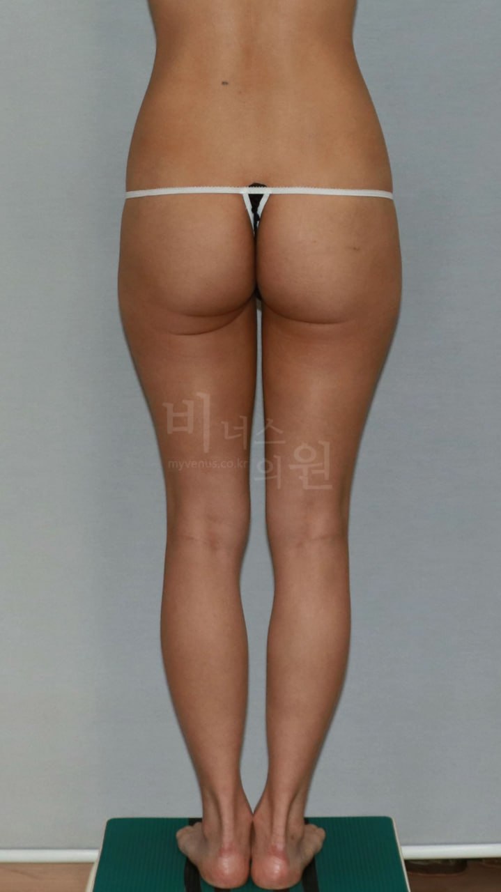 엉덩이 지방흡입 사례 1 수술 전 후면 비너스의원