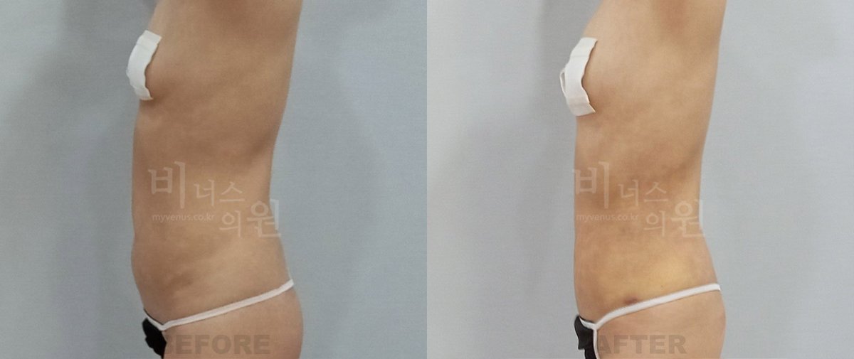 복부 지방흡입 전후사진 측면 전후 - 비너스의원