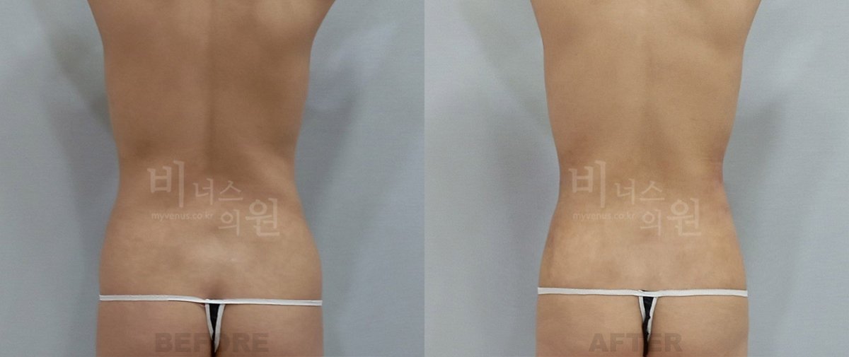 복부 지방흡입 전후사진 후면 전후 - 비너스의원