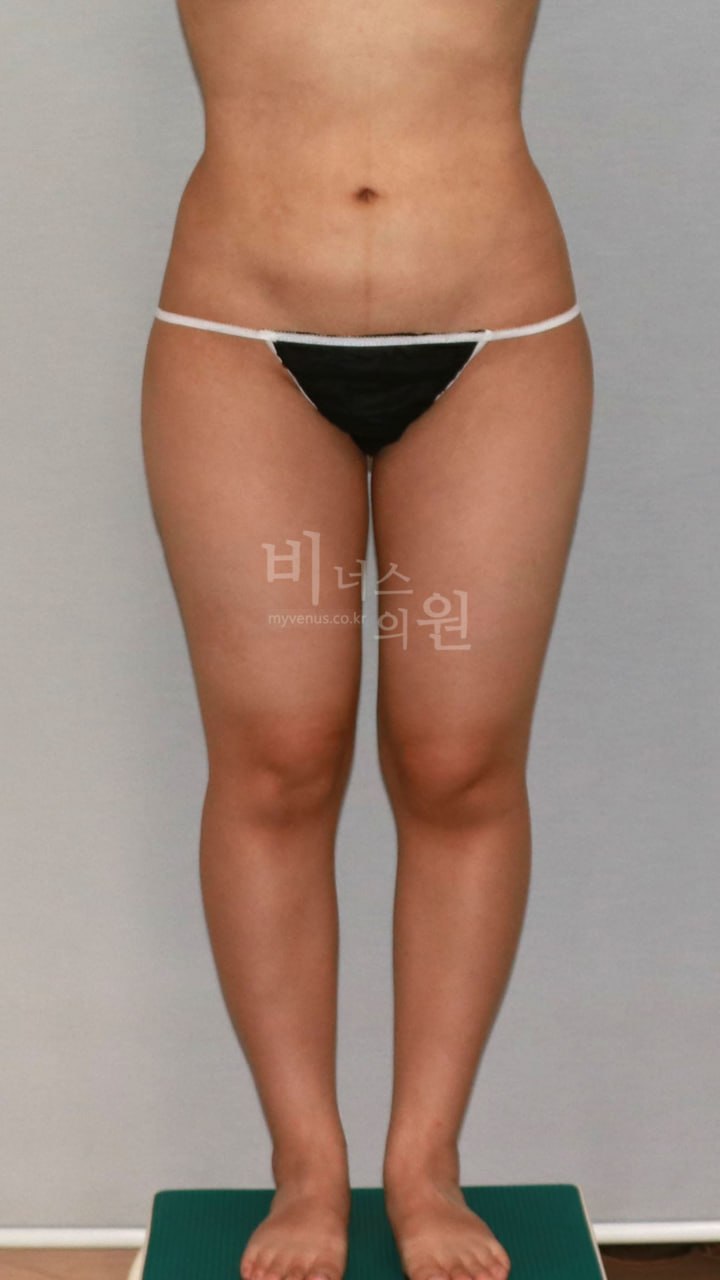 허벅지 지방흡입 수술 전 정면 비너스의원