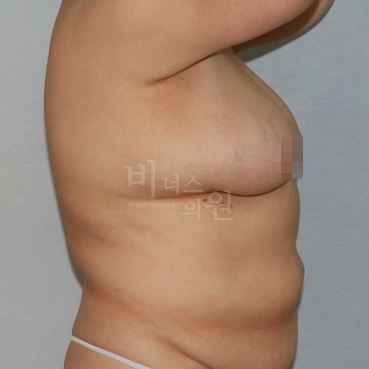 가슴축소 지방흡입 전후사진 CASE 5