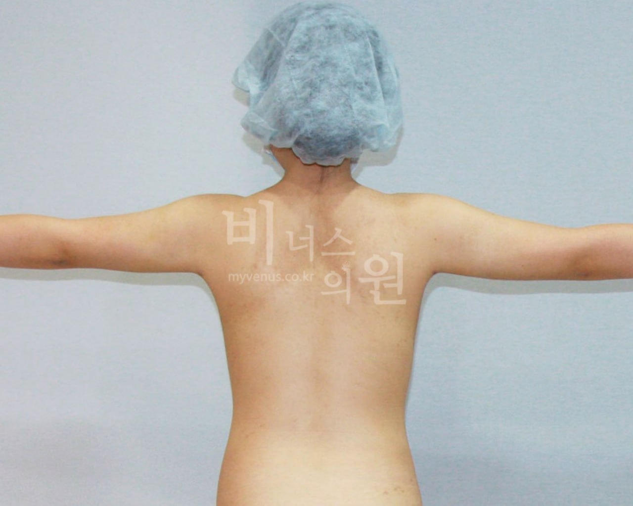 팔뚝 지방흡입 수술 후 후면 비너스의원