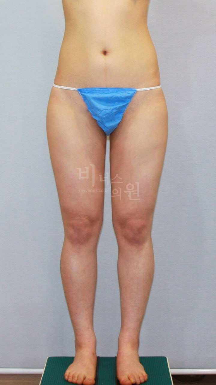 허벅지 지방흡입 수술 전 정면 비너스의원