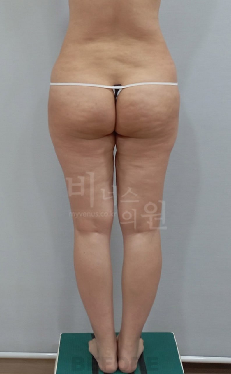 엉덩이축소 지방흡입 수술 전 사례 3 비너스의원