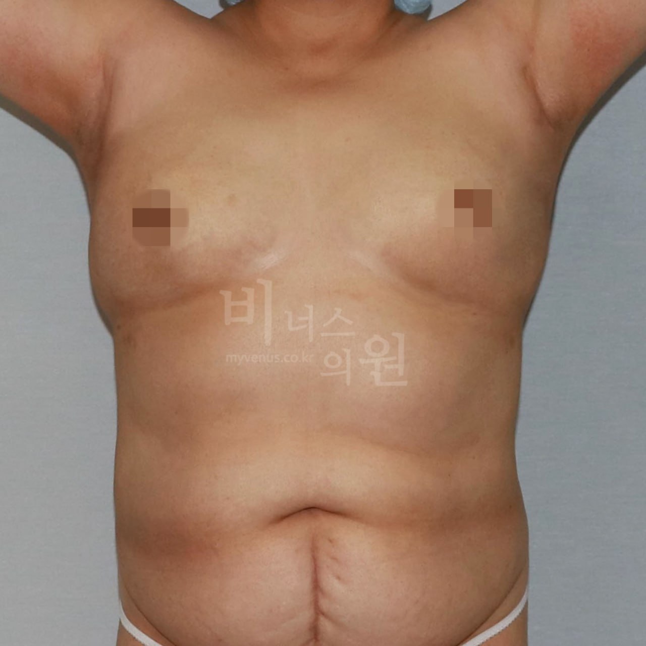 가슴축소 지방흡입 전후사진 CASE 2