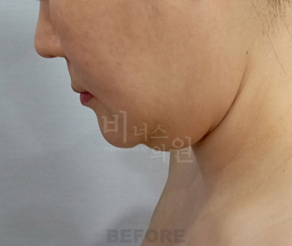 얼굴 이중턱 지방흡입 수술 전 우측면 비너스의원