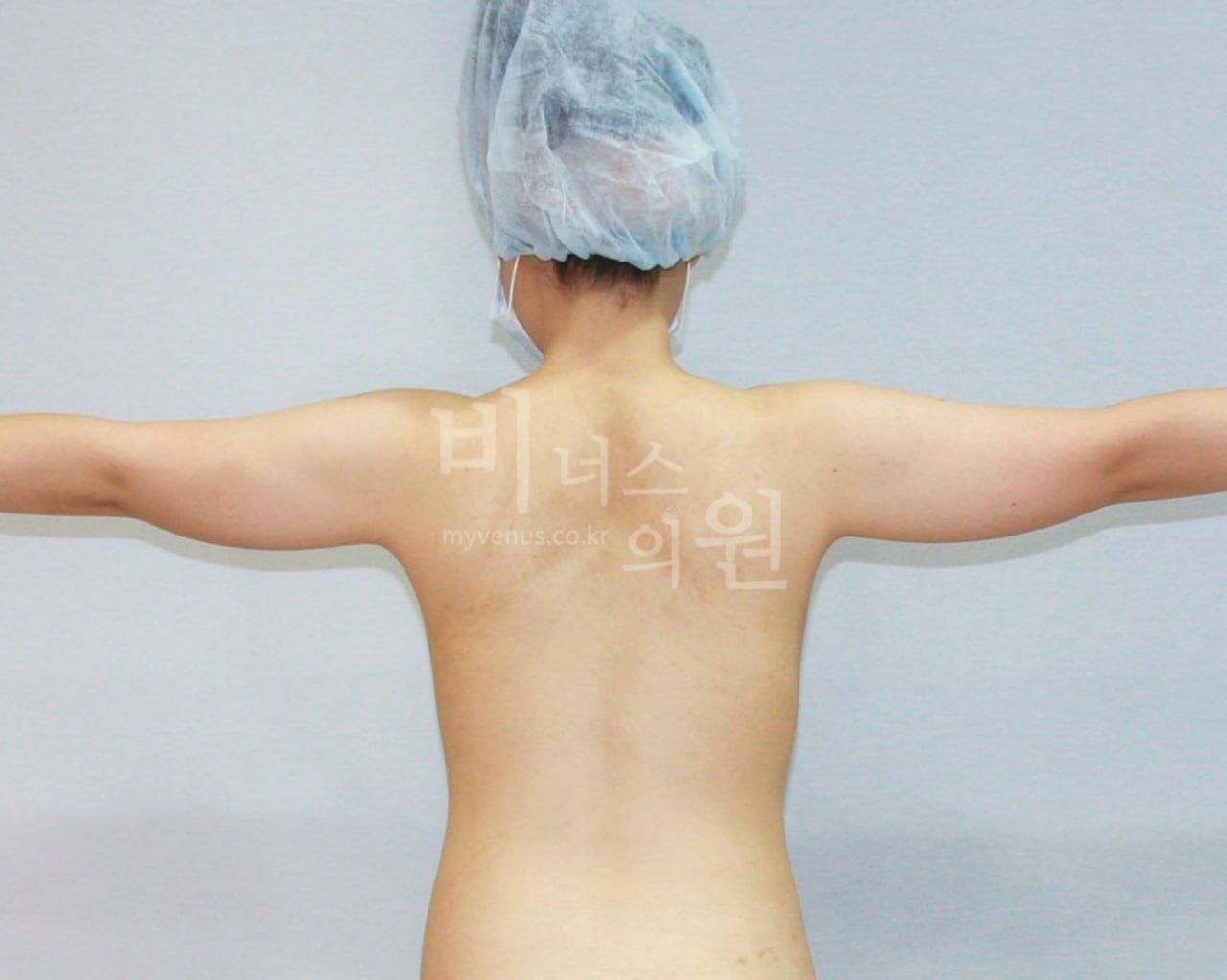 팔뚝 지방흡입 수술 전 후면 비너스의원