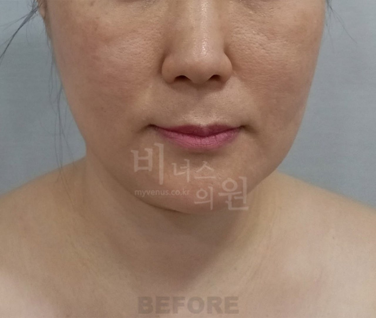 얼굴 이중턱 지방흡입 수술 전 정면 비너스의원