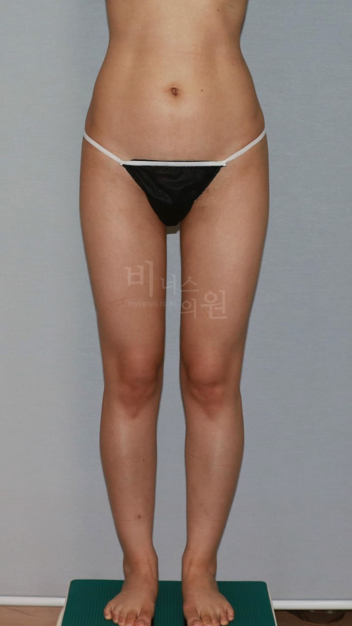 엉덩이 지방흡입 후 정면