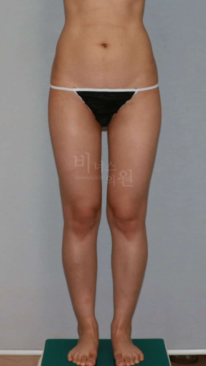 엉덩이 지방흡입 전 정면