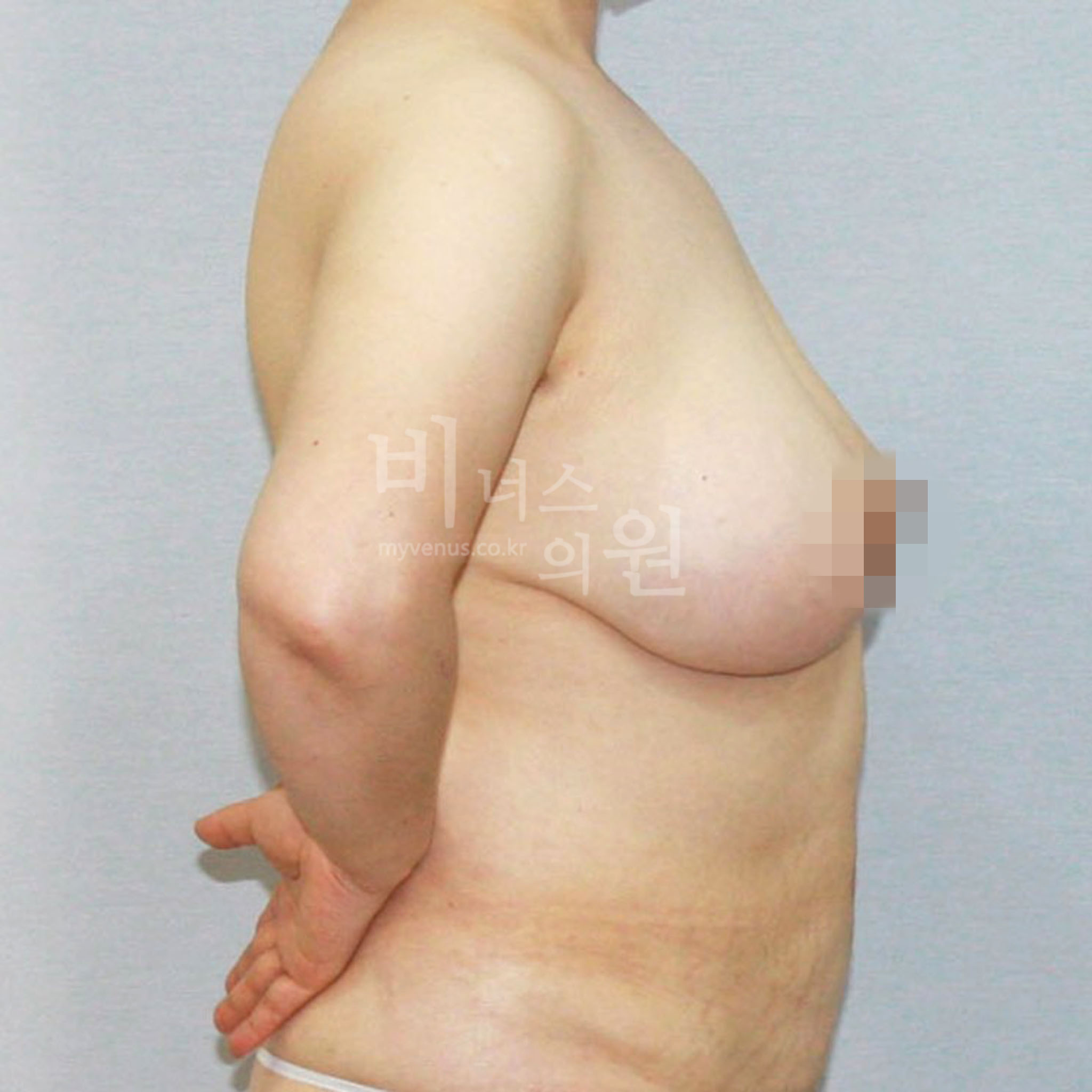 가슴축소 지방흡입 전후 (측면) 수술 전 비너스의원